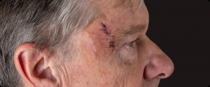 Understanding Advanced Skin Care and Cancer Treatment Options in Mat-Su, Alaska