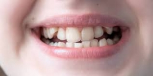 What Are the Best Braces for Overlapping Teeth?