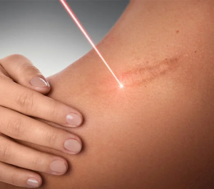 Scar Treatment at Dr. Monisha Kapoor Aesthetics: Restore Confidence, Renew Your Skin