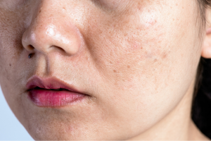 How Does Pigmentation Treatment Work?