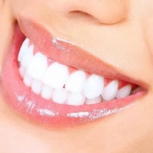 How Much Does Laser Teeth Whitening Cost in Islamabad?