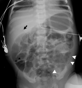 Necrotising Enterocolitis Market Growth and Forecast Insights