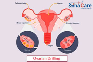 Breakthrough Fertility Treatment: Laparoscopic Ovarian Drilling in India for PCOS Women