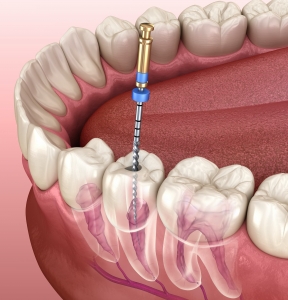 Aesthetic Root Canal Results in Dubai