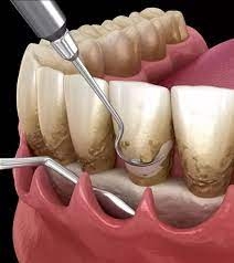 Is Gingivectomy Painful? What to Expect During the Procedure