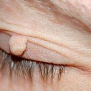 How to Remove a Skin Tag from Eyelid: Expert Treatment Process