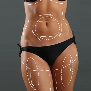 Smooth Your Silhouette with Advanced Liposuction