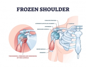 Understanding Frozen Shoulder: Causes, Symptoms, and Expert Treatment by Dr. Ishan Shevate in Pune