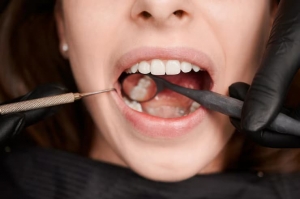 The Process of Applying Dental Sealants Explained
