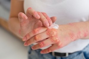 Exploring the Growth of the Atopic Dermatitis Market: Innovations, Challenges, and Future Outlook