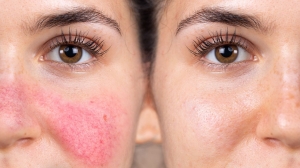 The Role of Fractional RF Microneedling in Rosacea Treatment