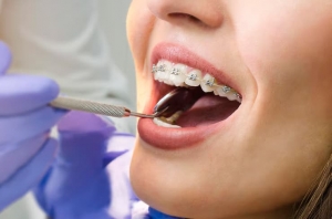 Braces, Aligners & More: What Orthodontic Services Near Me Offer