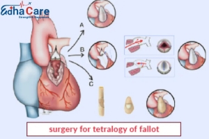 Healing Little Hearts: Advanced Tetralogy of Fallot Treatment in India