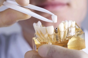 Why Dental Crowns and Bridges Are Essential for Restoring Smiles in Parramatta