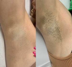 Invest in Smooth Skin: Is Laser Hair Removal Worth the Cost?