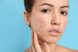 Cost vs. Results: Acne Scar Treatment in Islamabad Explained