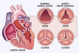 Advanced Aortic Stenosis Treatment in India: High Success at Affordable Cost