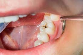 How Do I Know If I Need a Filling?