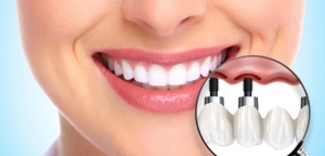 Reignite Your Spark with Dental Implants in Dubai