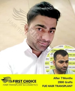 Reviving Confidence with Expert Hair Solutions in Punjab: Trusted Clinics in Chandigarh & Ludhiana