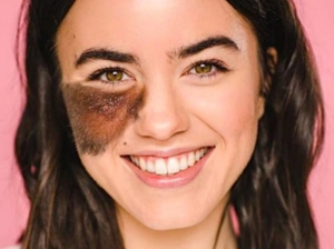 How do vascular birthmarks get treated?