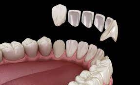 How to Maintain Your Composite Veneers?