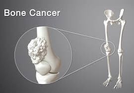 Bone Cancer Treatment in India: Advanced Healing with Compassion and Cost-Efficiency