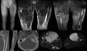 Soft Tissue Sarcoma Market: Size, Trends, Growth, and Key Insights 2025-2032
