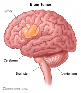 What is a Brain Tumor? Types, Symptoms, and treatment of brain tumor