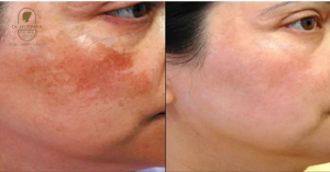 Melasma Treatment