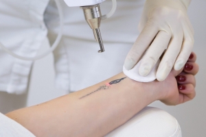 Is PicoSure Laser Removal Safe for Sensitive Skin?