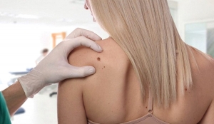 Skin Tag Freezing Options in Dubai