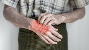 Bullous Pemphigoid Market Size, Trends, and Forecast Analysis 2025-2032