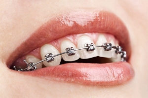 From Braces to Aligners: How Orthodontists Help You Choose Wisely