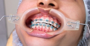 Is It Normal for Metal Braces to Hurt at First?