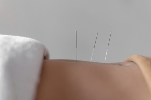 Experience Natural Healing with Acupuncture in Louisville