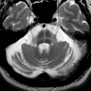 Multiple System Atrophy (MSA) Market Size, Trends, and Growth Forecast 2025-2032