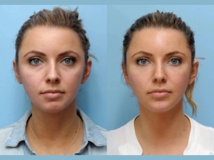 Best Aesthetic Clinic in Dubai Shares What to Expect from a Thread Lift Procedure