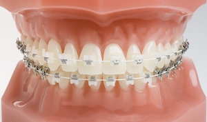 How to Choose the Right Orthodontist for Your Dental Braces