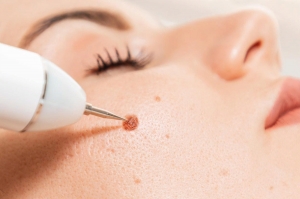 Warts in Sensitive Areas: Confidential Removal in Islamabad