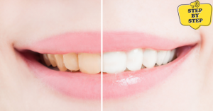 Step-by-Step Guide to Teeth Whitening with a Bleaching Kit