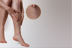 The Role of Specialists in Managing Varicose Vein Conditions