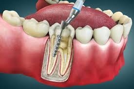 Is Root Canal Treatment Painful?