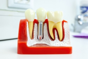 Dental Implant 3D Model