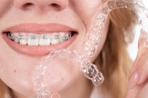 Aligners and Diet: What You Can and Can’t Eat