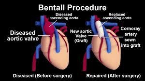 Restoring Hearts, Saving Lives: Bentall Procedure in India Explained