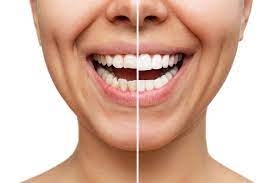 Do Dental Veneers Hurt? Common Patient Questions