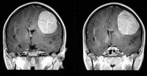 Top Trends In The Glioblastoma Market Size 2025: Advancing Breakthrough Brain Cancer Treatments
