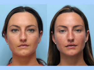 Experience the Art of Facial Sculpting with Thread Lift in Dubai