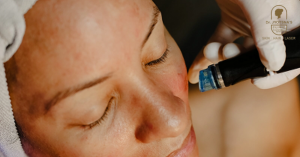 Hydra Facial Treatment